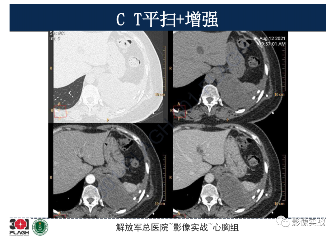 影像PPT - 【病例】左侧胸腔孤立性纤维肿瘤1例CT-12