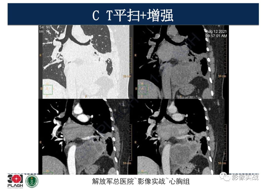 影像PPT - 【病例】左侧胸腔孤立性纤维肿瘤1例CT-14