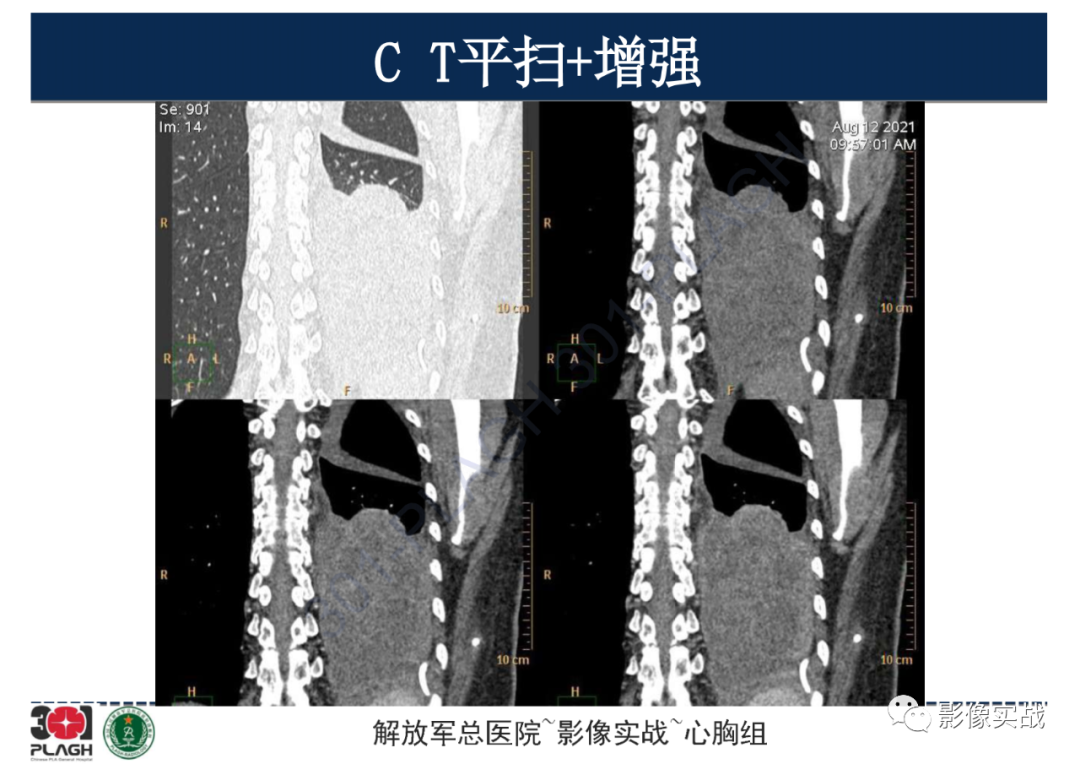 影像PPT - 【病例】左侧胸腔孤立性纤维肿瘤1例CT-16