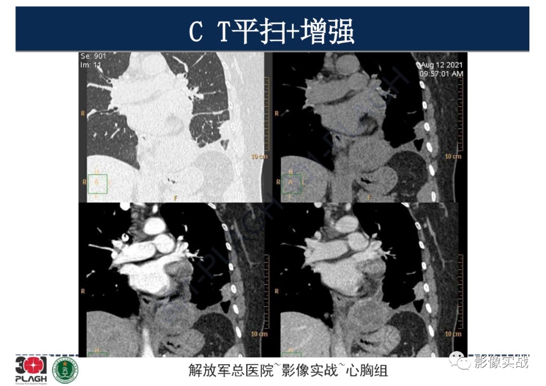 影像PPT - 【病例】左侧胸腔孤立性纤维肿瘤1例CT-13