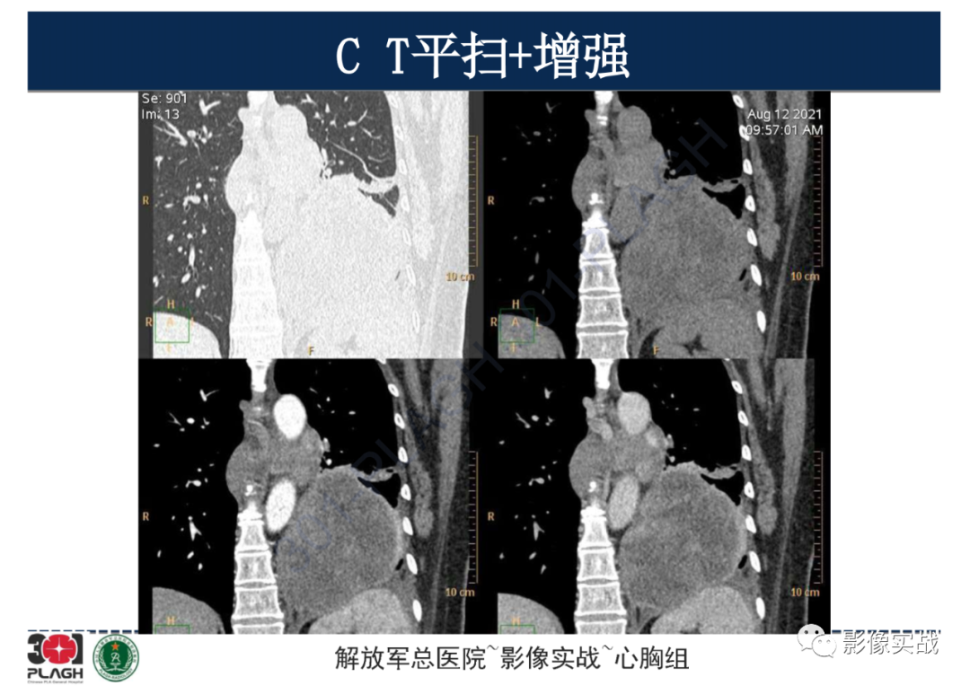 影像PPT - 【病例】左侧胸腔孤立性纤维肿瘤1例CT-15