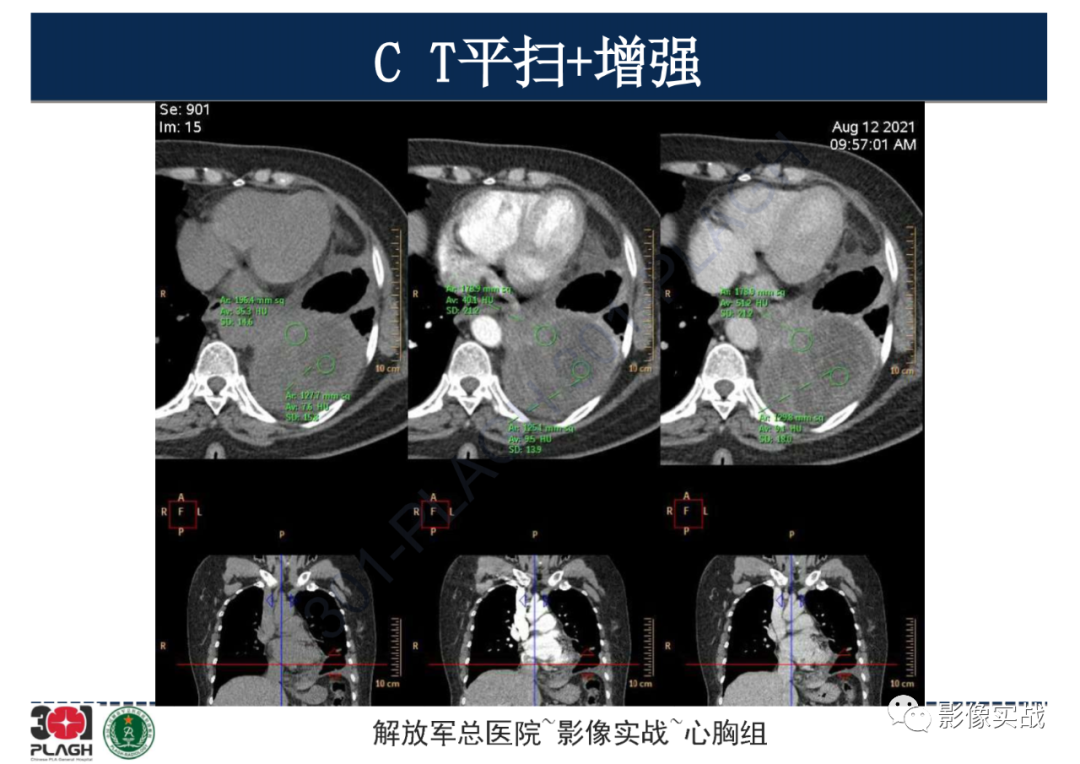 影像PPT - 【病例】左侧胸腔孤立性纤维肿瘤1例CT-17