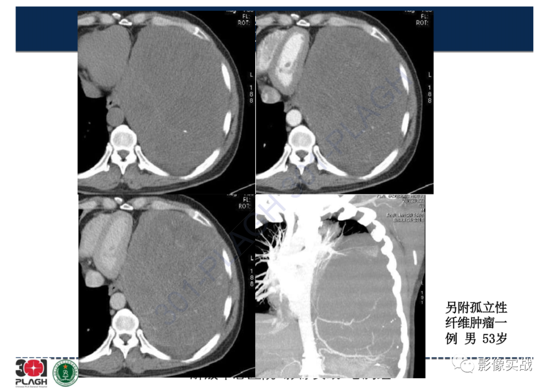 影像PPT - 【病例】左侧胸腔孤立性纤维肿瘤1例CT-23