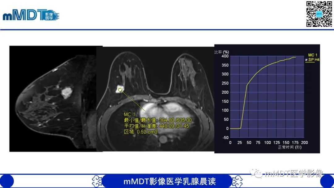 影像PPT - 【病例】乳腺叶状瘤1例X线MR影像分析-6