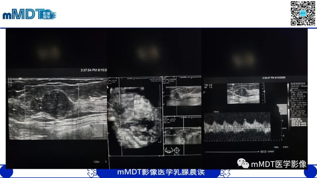 影像PPT - 【病例】乳腺叶状瘤1例X线MR影像分析-4