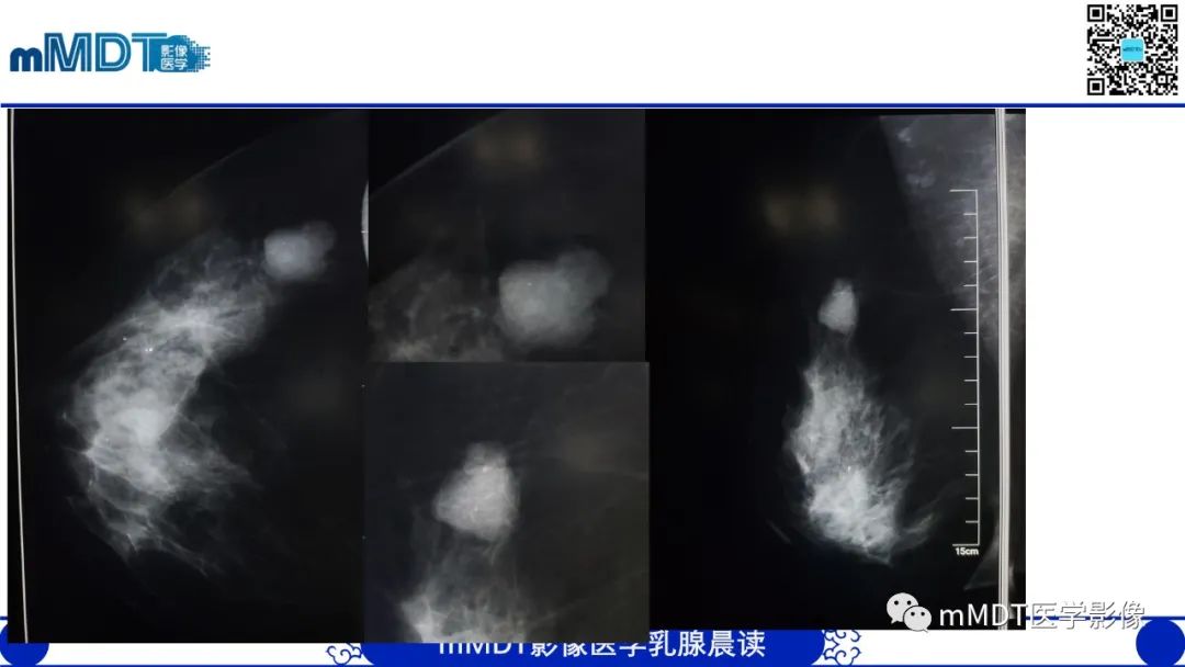 影像PPT - 【病例】乳腺叶状瘤1例X线MR影像分析-3