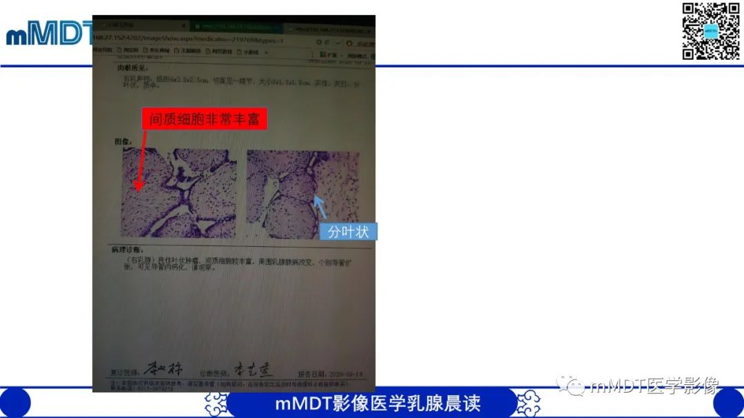 影像PPT - 【病例】乳腺叶状瘤1例X线MR影像分析-10