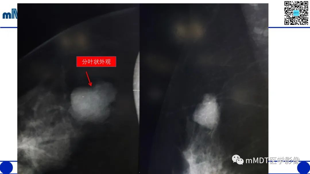 影像PPT - 【病例】乳腺叶状瘤1例X线MR影像分析-9