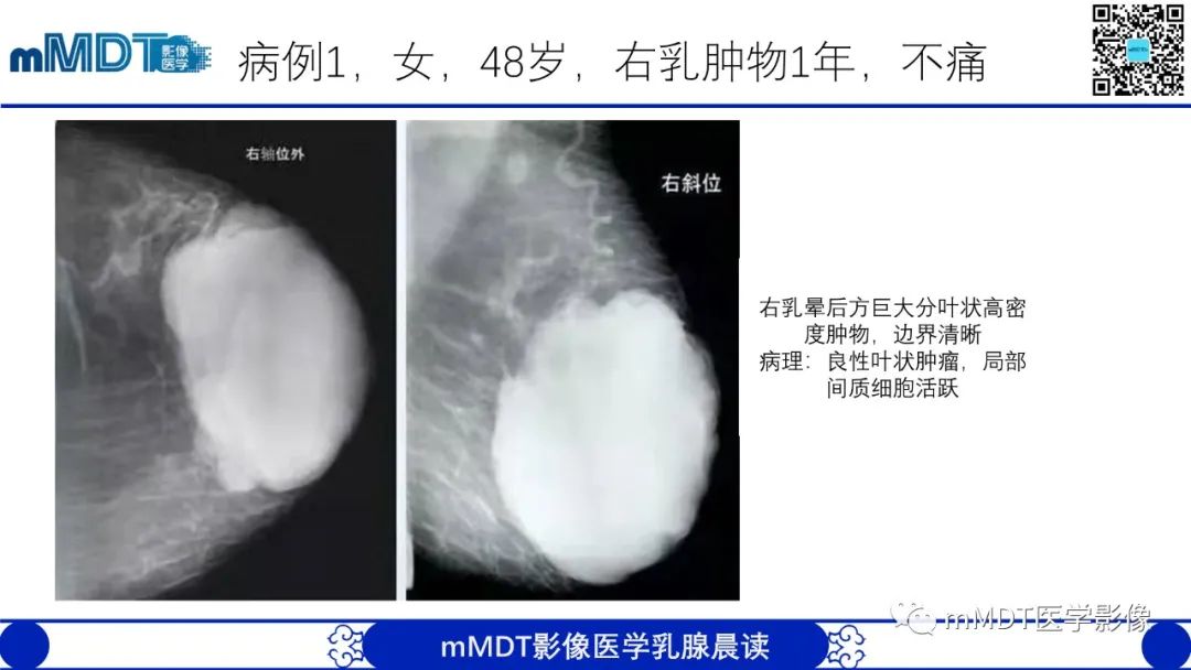 影像PPT - 【病例】乳腺叶状瘤1例X线MR影像分析-16