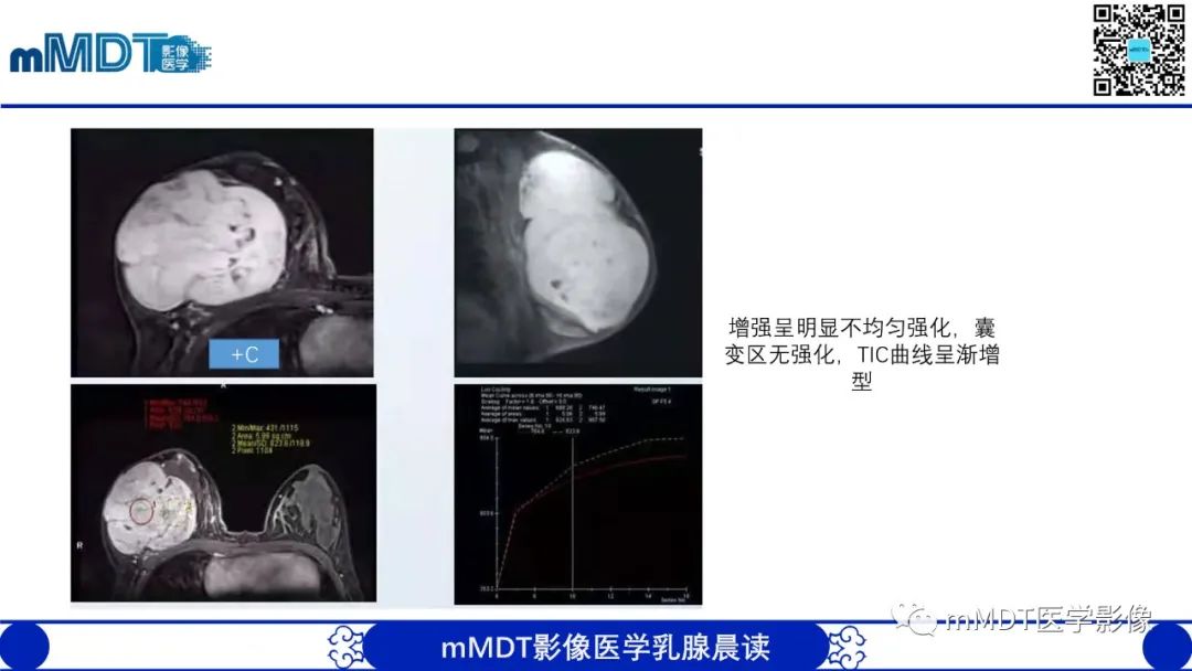 影像PPT - 【病例】乳腺叶状瘤1例X线MR影像分析-18