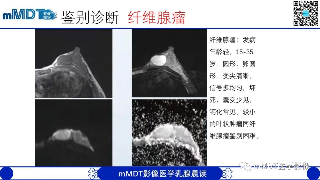 影像PPT - 【病例】乳腺叶状瘤1例X线MR影像分析-19