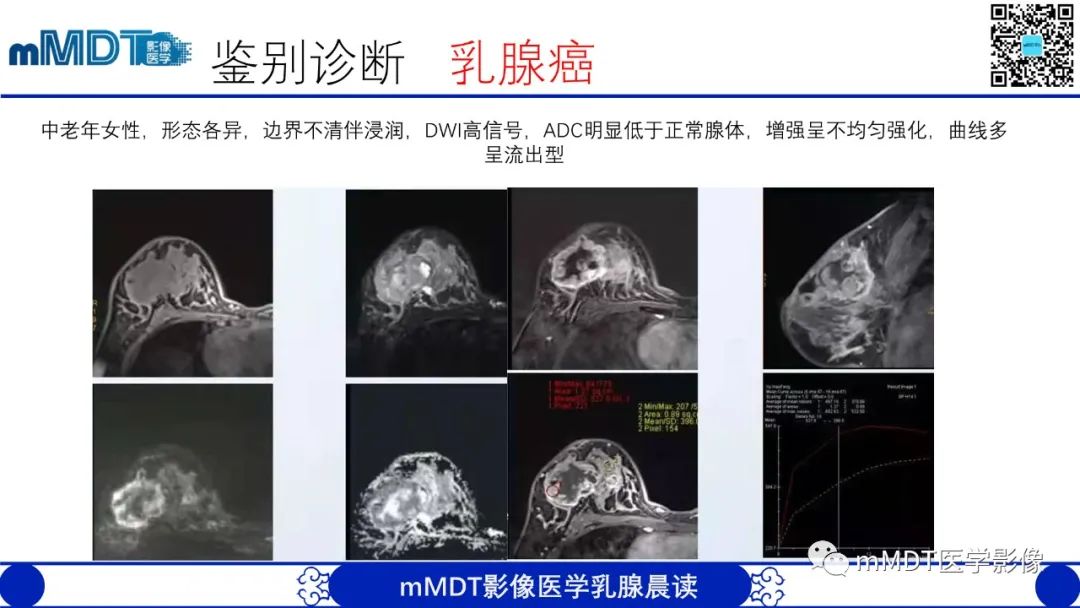 影像PPT - 【病例】乳腺叶状瘤1例X线MR影像分析-20