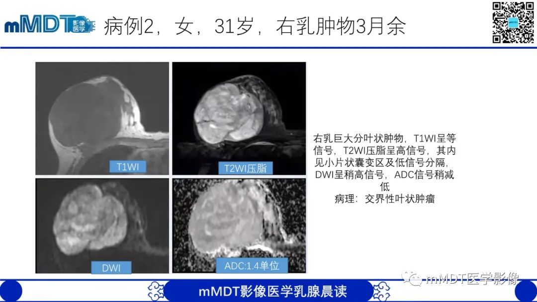 影像PPT - 【病例】乳腺叶状瘤1例X线MR影像分析-17