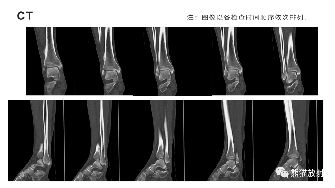 影像PPT - 【病例】骨样骨瘤 VS 骨髓炎-4