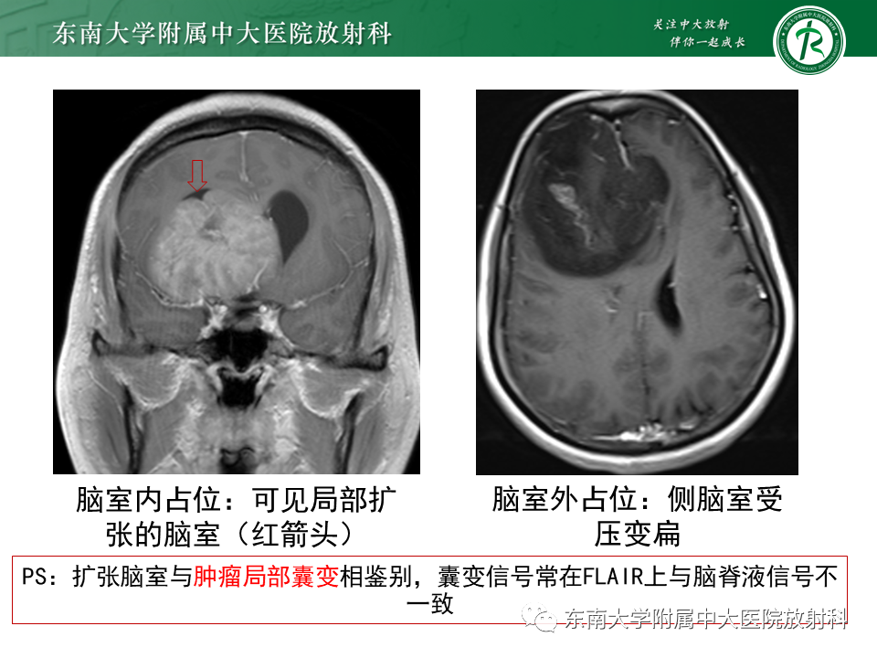 影像PPT - 【PPT】常见侧脑室占位影像诊断-11 影像PPT - 【PPT】常见侧脑室占位影像诊断-11