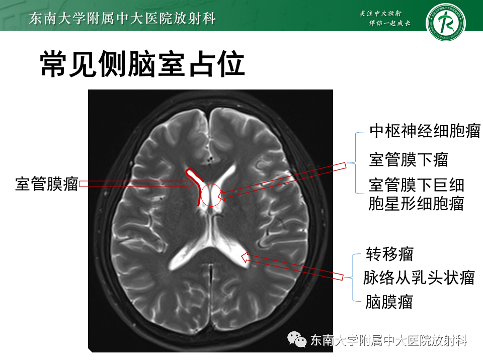 影像PPT - 【PPT】常见侧脑室占位影像诊断-8 影像PPT - 【PPT】常见侧脑室占位影像诊断-8