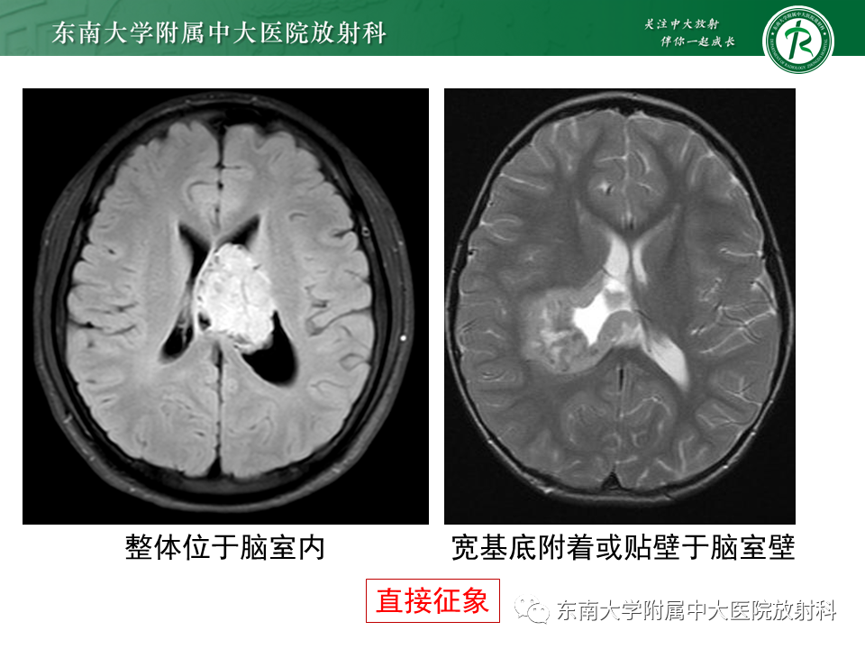 影像PPT - 【PPT】常见侧脑室占位影像诊断-10 影像PPT - 【PPT】常见侧脑室占位影像诊断-10