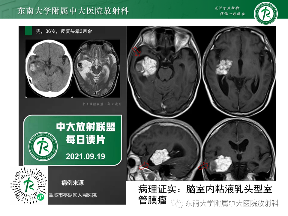 影像PPT - 【PPT】常见侧脑室占位影像诊断-12 影像PPT - 【PPT】常见侧脑室占位影像诊断-12