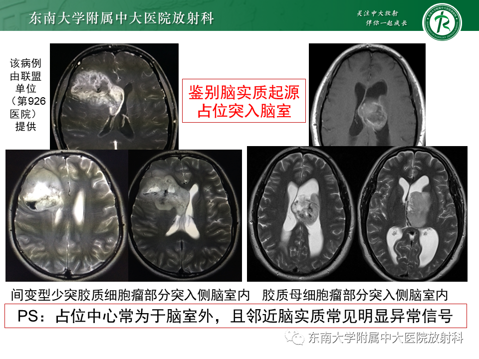 影像PPT - 【PPT】常见侧脑室占位影像诊断-16 影像PPT - 【PPT】常见侧脑室占位影像诊断-16