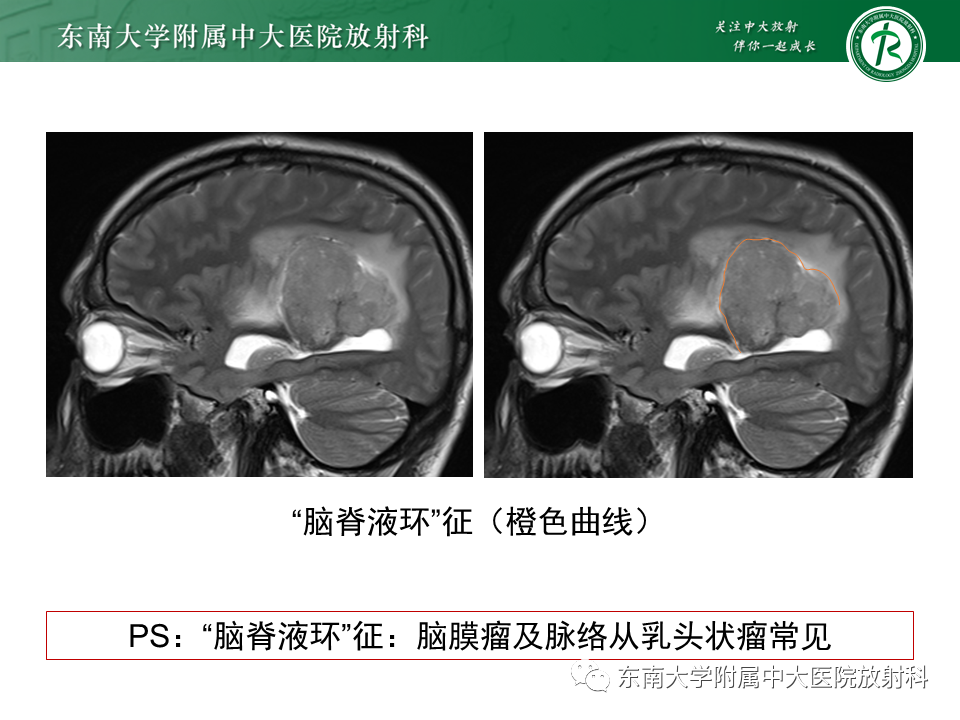 影像PPT - 【PPT】常见侧脑室占位影像诊断-13 影像PPT - 【PPT】常见侧脑室占位影像诊断-13