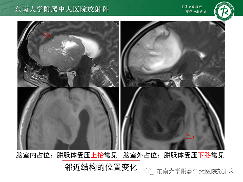 影像PPT - 【PPT】常见侧脑室占位影像诊断-15 影像PPT - 【PPT】常见侧脑室占位影像诊断-15
