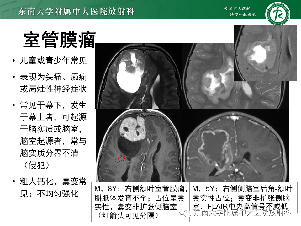 影像PPT - 【PPT】常见侧脑室占位影像诊断-17 影像PPT - 【PPT】常见侧脑室占位影像诊断-17