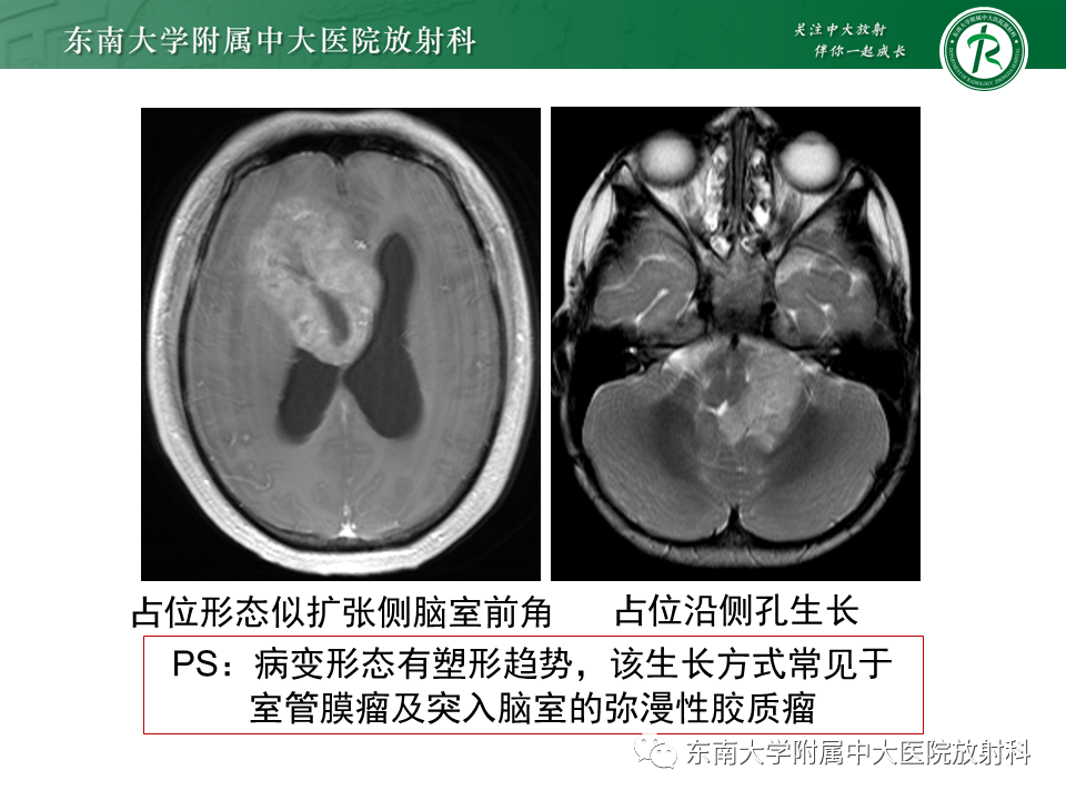 影像PPT - 【PPT】常见侧脑室占位影像诊断-14 影像PPT - 【PPT】常见侧脑室占位影像诊断-14