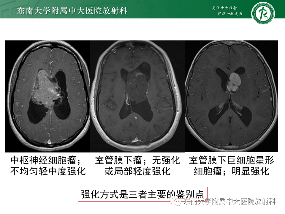 影像PPT - 【PPT】常见侧脑室占位影像诊断-23 影像PPT - 【PPT】常见侧脑室占位影像诊断-23