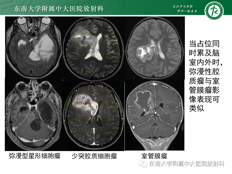 影像PPT - 【PPT】常见侧脑室占位影像诊断-18 影像PPT - 【PPT】常见侧脑室占位影像诊断-18