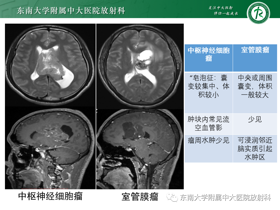 影像PPT - 【PPT】常见侧脑室占位影像诊断-20 影像PPT - 【PPT】常见侧脑室占位影像诊断-20