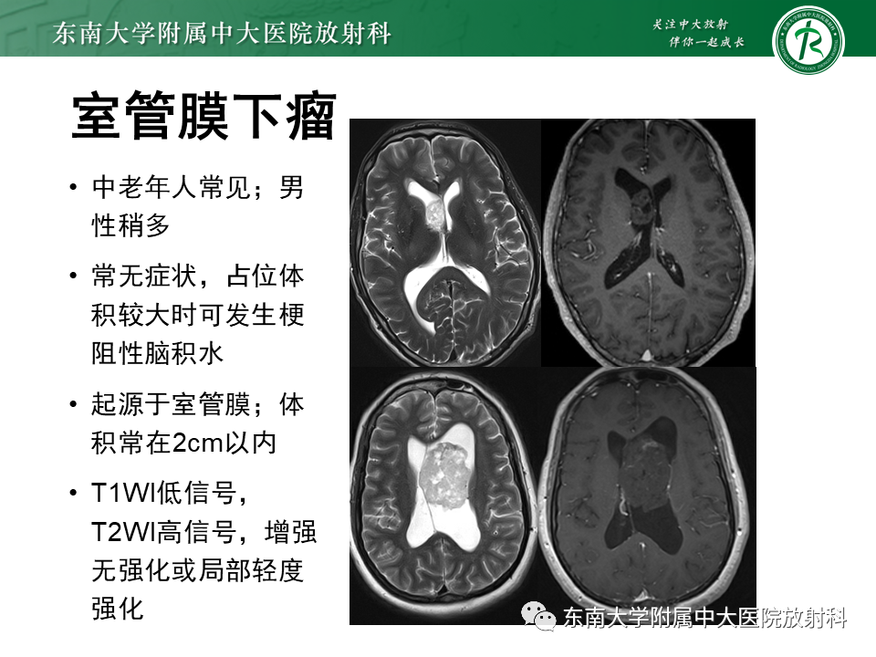 影像PPT - 【PPT】常见侧脑室占位影像诊断-21 影像PPT - 【PPT】常见侧脑室占位影像诊断-21