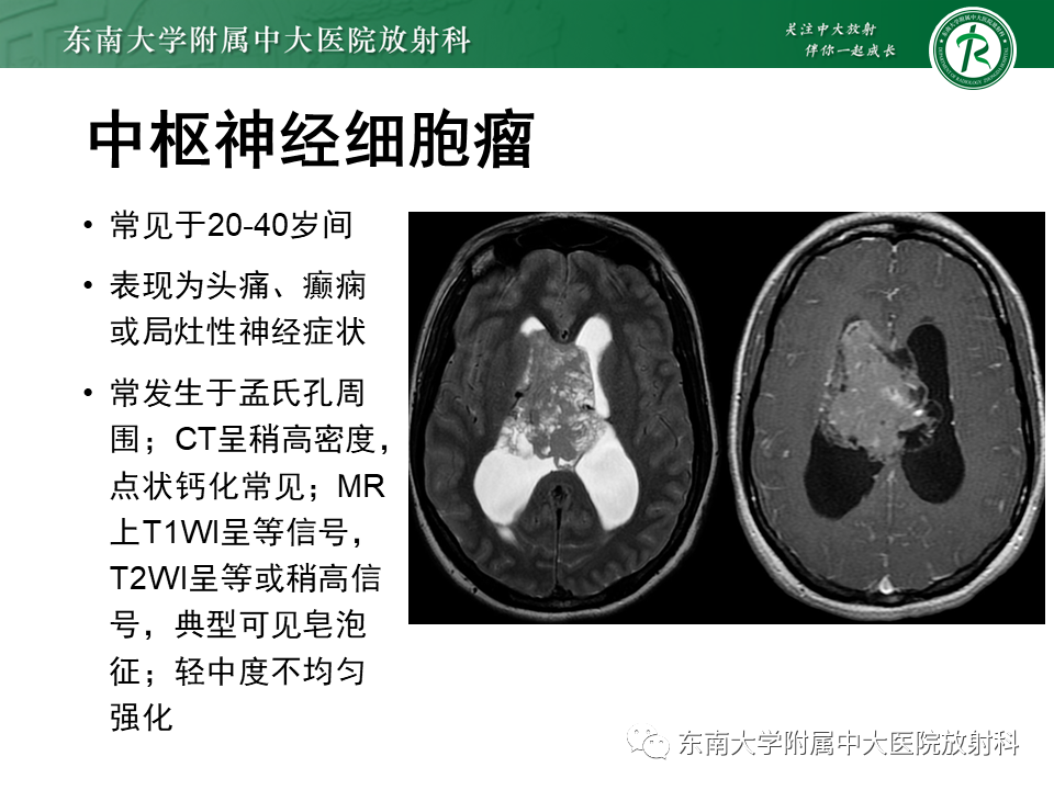 影像PPT - 【PPT】常见侧脑室占位影像诊断-19 影像PPT - 【PPT】常见侧脑室占位影像诊断-19