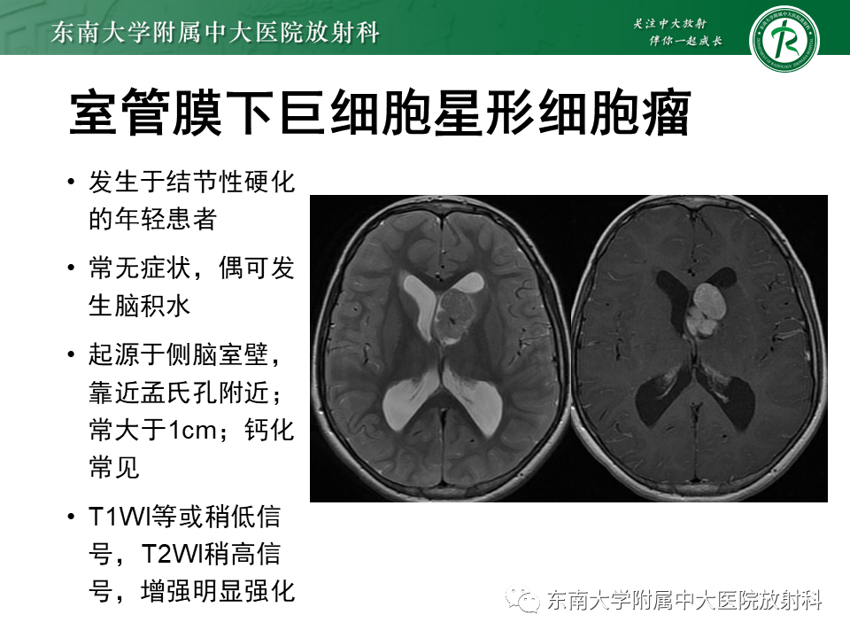 影像PPT - 【PPT】常见侧脑室占位影像诊断-22 影像PPT - 【PPT】常见侧脑室占位影像诊断-22