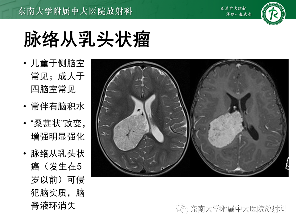影像PPT - 【PPT】常见侧脑室占位影像诊断-24 影像PPT - 【PPT】常见侧脑室占位影像诊断-24