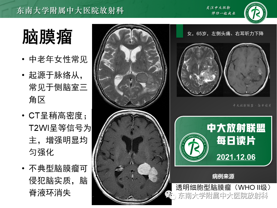 影像PPT - 【PPT】常见侧脑室占位影像诊断-25 影像PPT - 【PPT】常见侧脑室占位影像诊断-25