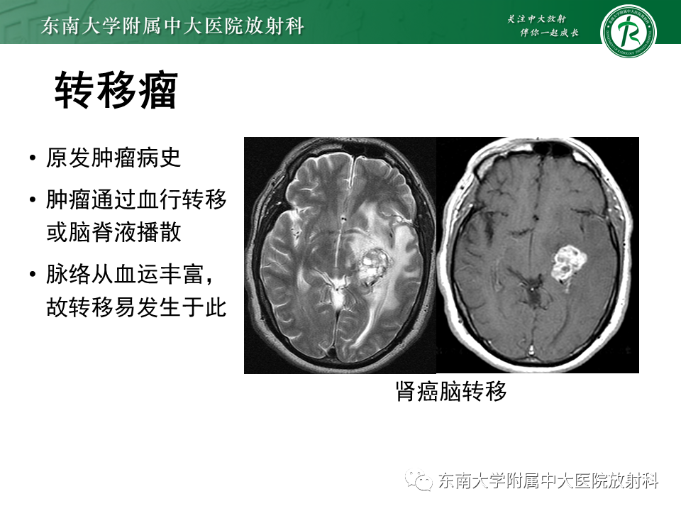 影像PPT - 【PPT】常见侧脑室占位影像诊断-26 影像PPT - 【PPT】常见侧脑室占位影像诊断-26