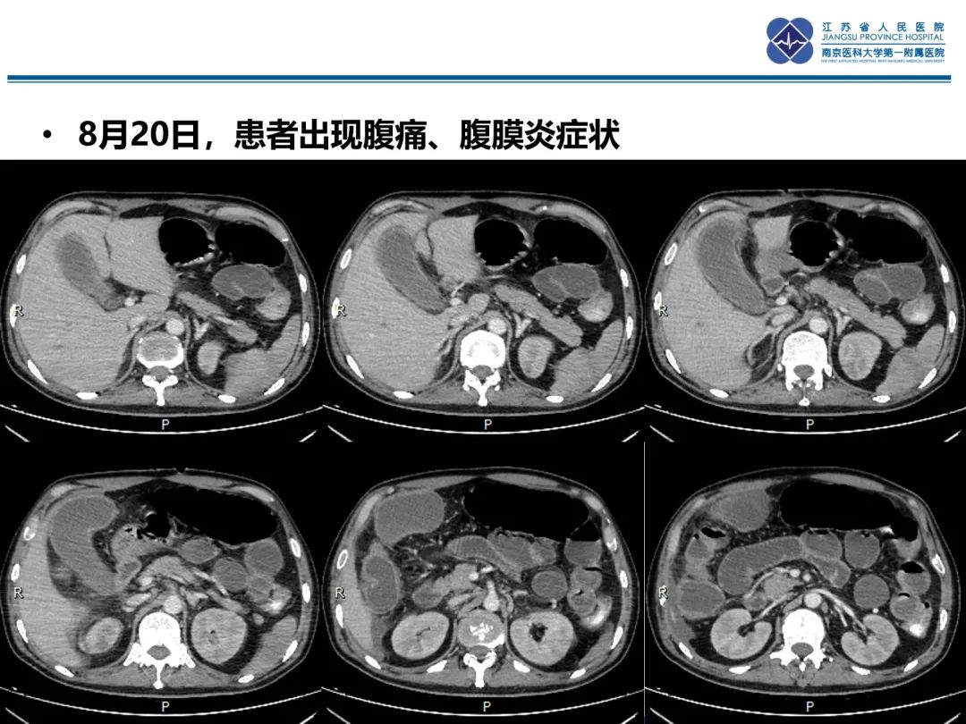 影像PPT - 【PPT】休克肠-8