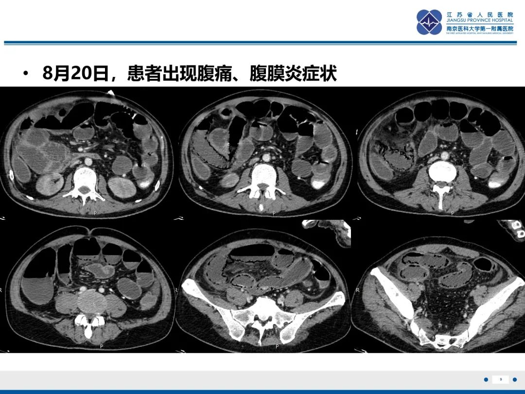 影像PPT - 【PPT】休克肠-9