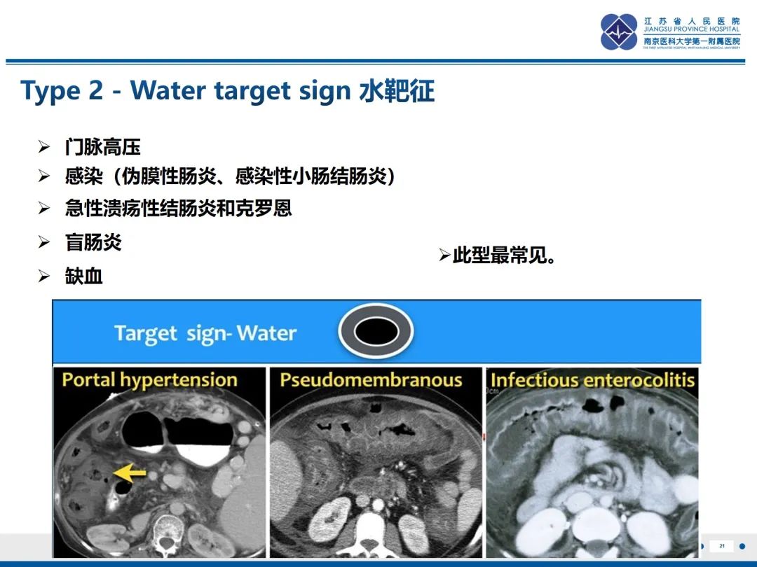 影像PPT - 【PPT】休克肠-21