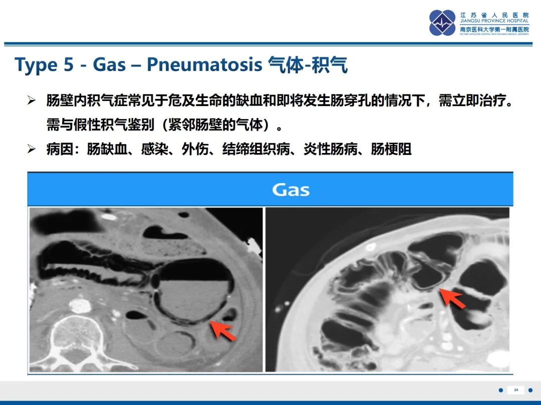 影像PPT - 【PPT】休克肠-24