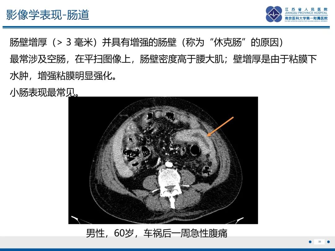 影像PPT - 【PPT】休克肠-33