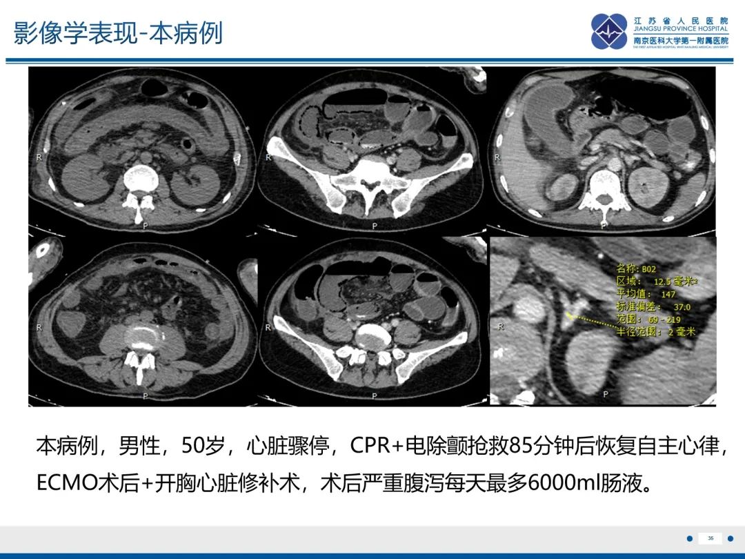 影像PPT - 【PPT】休克肠-35