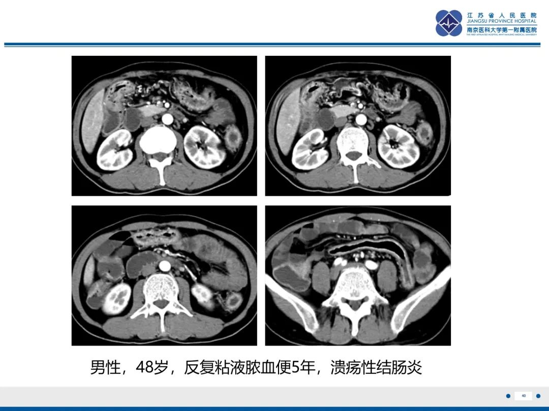 影像PPT - 【PPT】休克肠-40