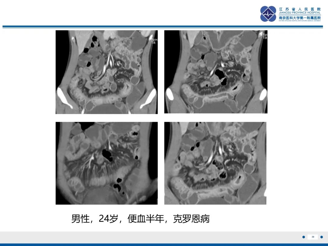 影像PPT - 【PPT】休克肠-39