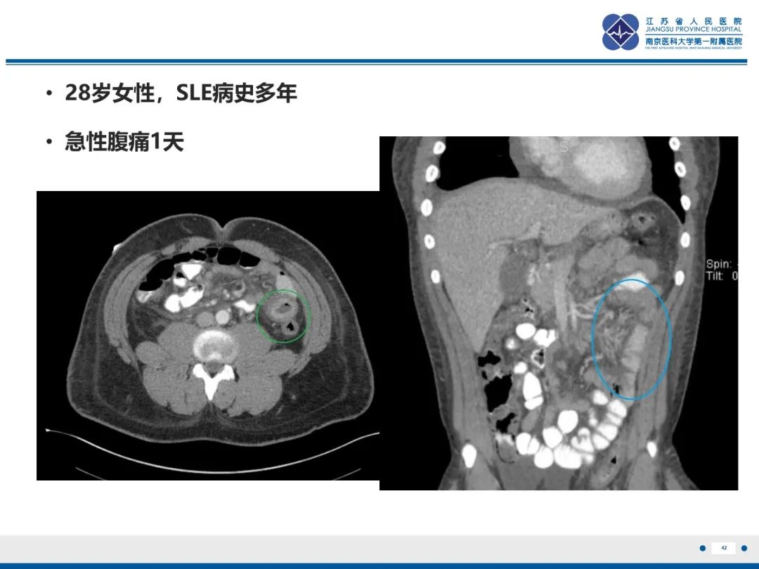 影像PPT - 【PPT】休克肠-42