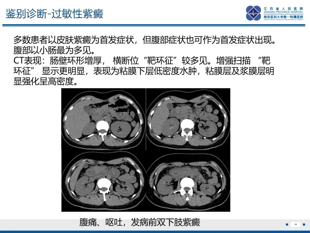 影像PPT - 【PPT】休克肠-44