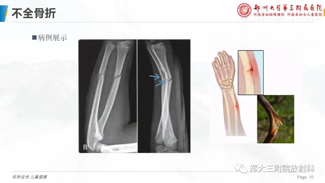 影像PPT - 【PPT】儿童骨折的影像诊断分析-10