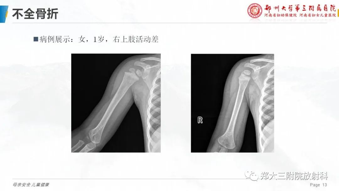 影像PPT - 【PPT】儿童骨折的影像诊断分析-13