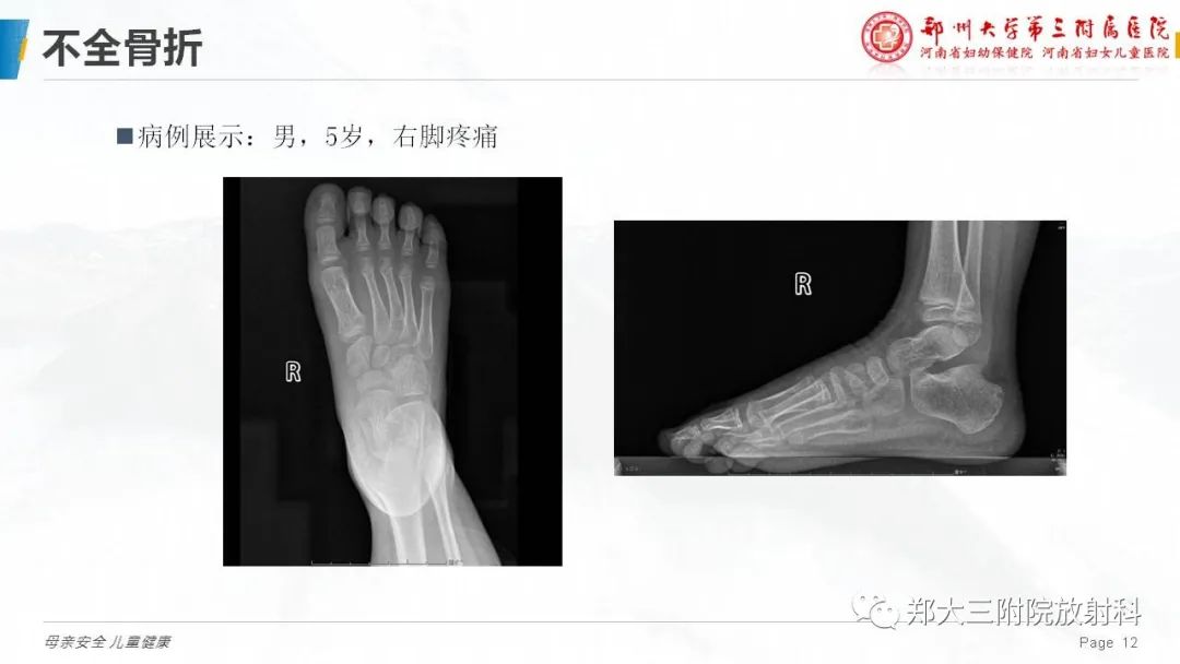 影像PPT - 【PPT】儿童骨折的影像诊断分析-12
