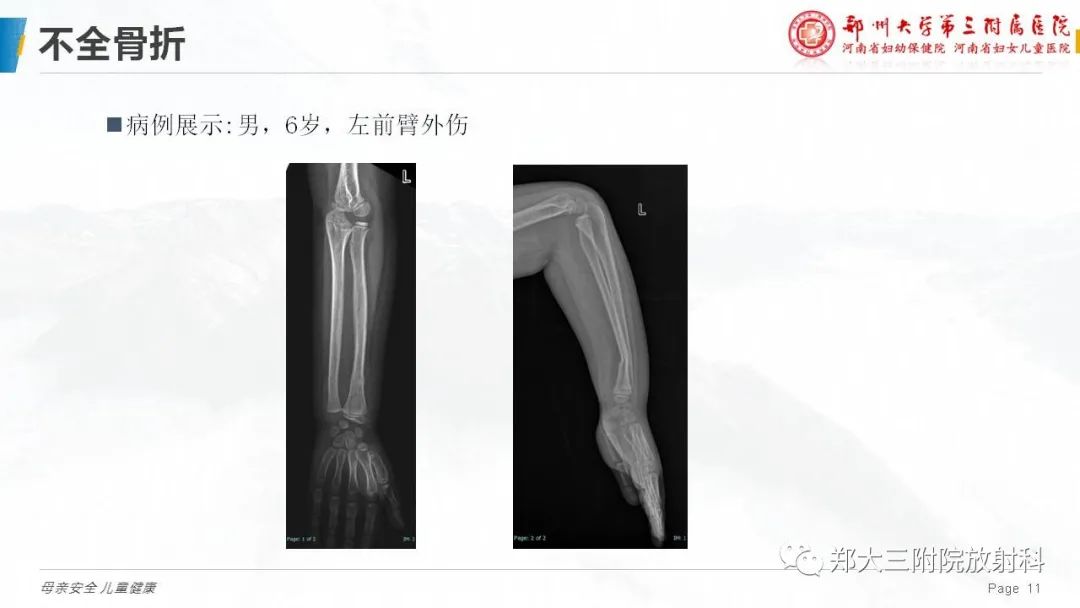 影像PPT - 【PPT】儿童骨折的影像诊断分析-11